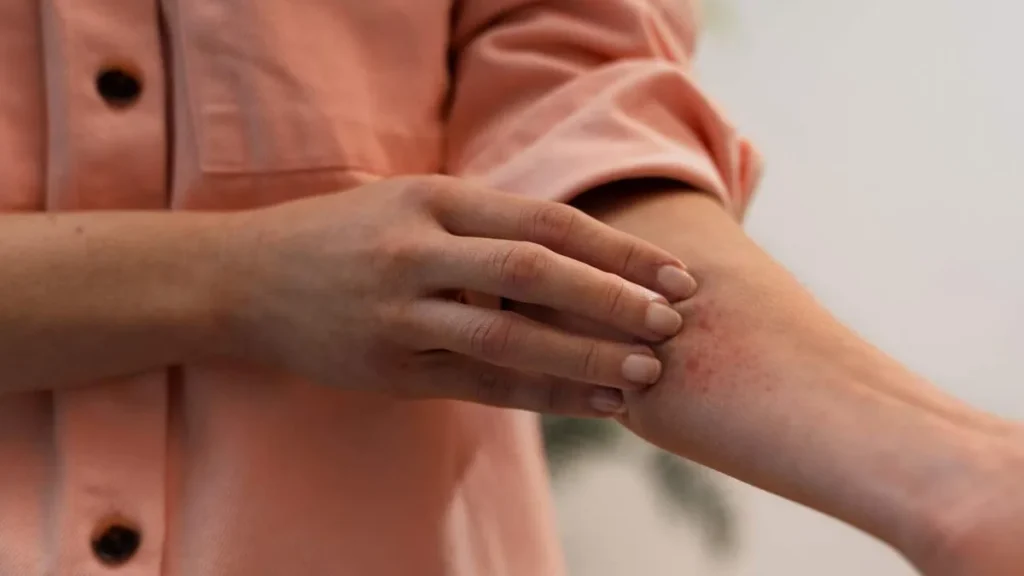 Imagem Mulher cocando o braco com a doenca de disidrose do artigo Disidrose: quando a pele fala através das mãos e dos pés